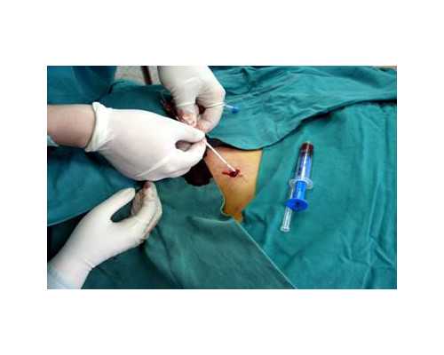 排卵障碍性不孕症的预防方法